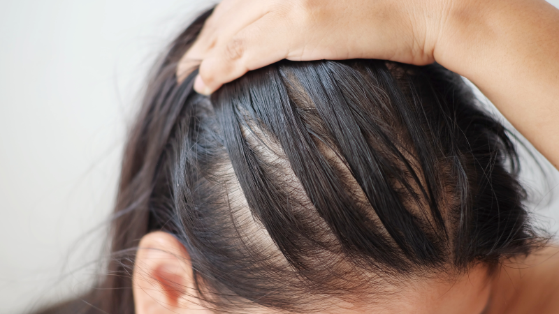 علت ریزش مو در زنان +درمان قطعی ریزش مو سر